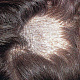 Волосы в очаге обламываются на высоте 4-6 мм, видны скопления белесоватых чешуек