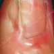 V-образное нарастание кожи на проксимальный отдел ногтя с прикреплением к ногтевому ложу
